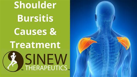 Shoulder Bursitis Causes and Treatment - YouTube