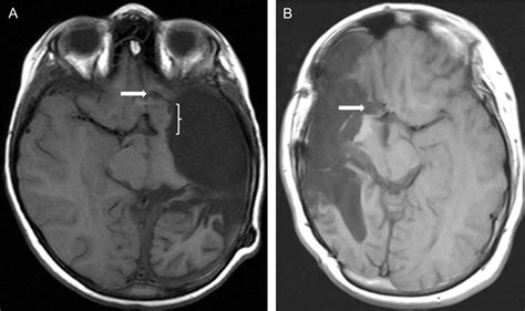 Posts tagged "hemispherectomy" - Neurosurgery Blog