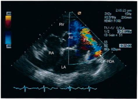 Patent ductus arteriosus in elderly patients: Clinical and echocardiographic features—a case ...