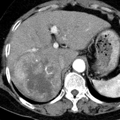 Hepatocellular Carcinoma Variants: Radiologic-Pathologic Correlation | AJR