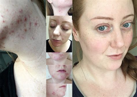 My Accutane Journey | Month 5: Cuts from crumbs and side effects update - Rachael Divers