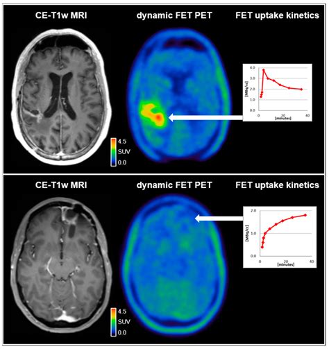 Cancers | Free Full-Text | Use of PET Imaging in Neuro-Oncological Surgery