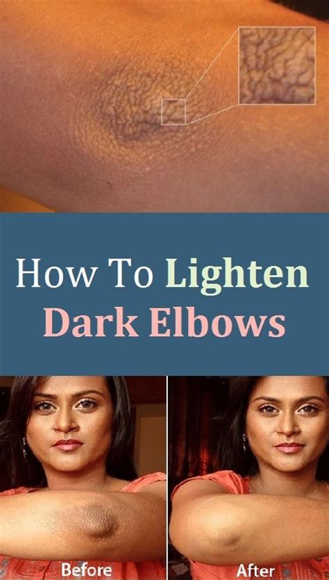 How To Lighten Dark Elbows? | Dark elbows, Skin hyperpigmentation ...