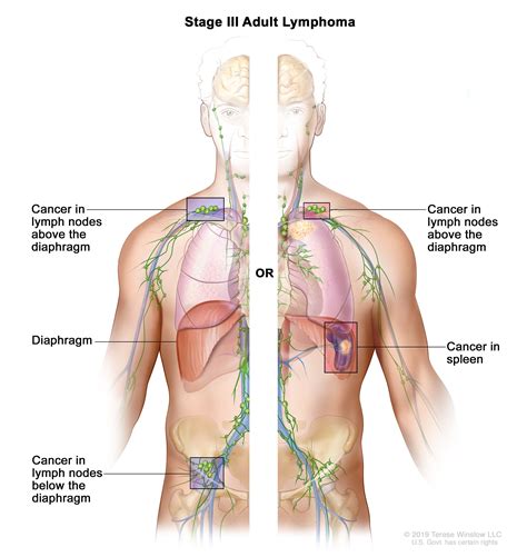 Non-Hodgkin Lymphoma Treatment - NCI