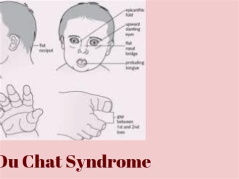 Cri Du Chat Syndrome Causes Of Cat's Cry Syndromes, 60% OFF