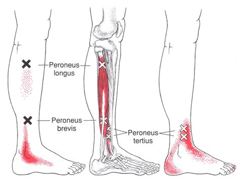 Peroneus Tertius | The Trigger Point & Referred Pain Guide