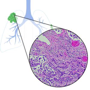 Squamous Cell Carcinoma Lung Cancer | Causes, Diagnosis, & Treatment