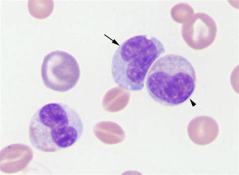 Immature neutrophils versus monocyte | eClinpath