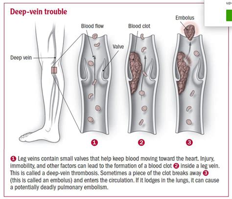 ACL Surgery Recovery Tips