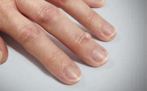 Finger-Cyst-2 - Skin Surgery Clinic