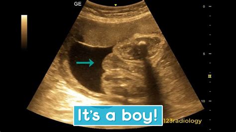 Ultrasound showing boy baby !!! - YouTube