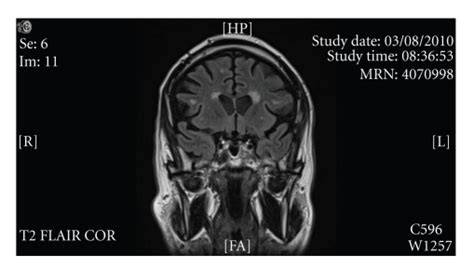 Periventricular and subcortical white matter hyperintensities. MRI,... | Download Scientific Diagram