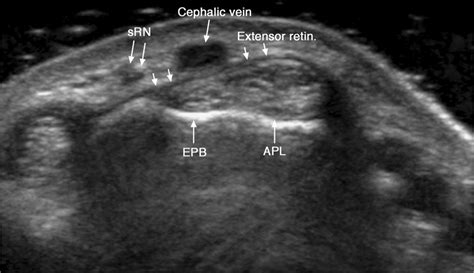 Extensor Tendon Ultrasound