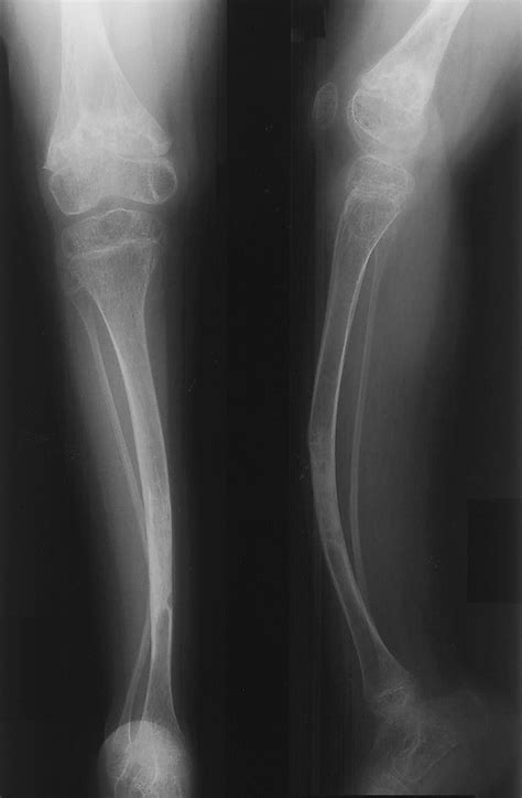 Osteogenesis Imperfecta (Brittle Bone Disease)