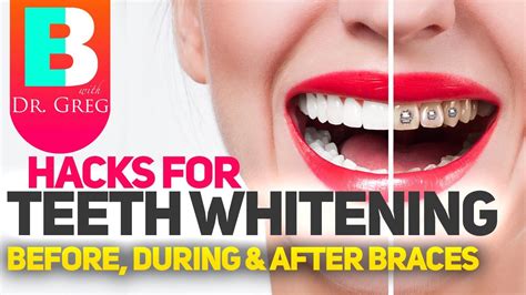 How To Whiten Teeth After Braces? Update - Linksofstrathaven.com