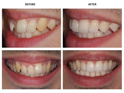 Inman Aligner before and after pictures - Inman Aligner