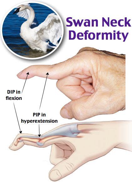 #Swan #Neck #Deformity | Medical anatomy, Medical studies, Nurse practitioner school