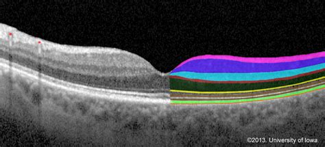 Retinal Detachment: From One Medical Student to Another