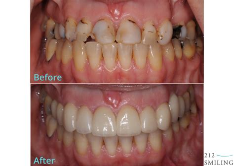 Female All Ceramic Crowns Before and After - 212 Smiling