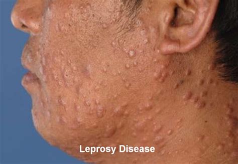 What Is Leprosy Disease And What Are The Symptoms Of Leprosy? | Health ...