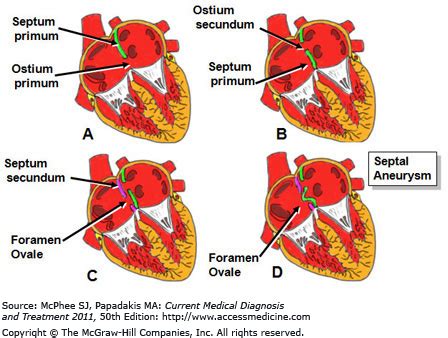 Primum vs secundum atrial septal defect | Student Doctor Network