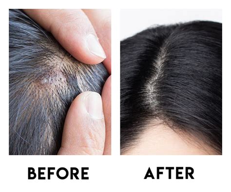 Scalp Acne Removal Treatment Singapore | Try for $28