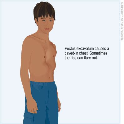 pectus excavatum baby breathing - It Was A Great Blogs Lightbox