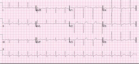 Dr. Smith's ECG Blog: August 2011