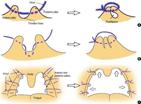 Figure 1:The Effect of Uvula-Preserving Palatopharyngoplasty in Obstructive Sleep Apnea on ...