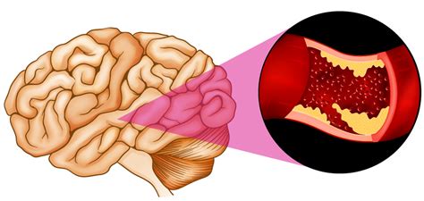 Ischemic Stroke | Altair Health