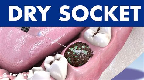 Dry Socket Treatment