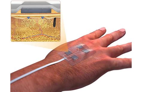 These ‘smart’ bandages could heal chronic wounds - MassDevice