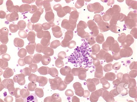 Essential thrombocythemia: peripheral smear - 1.