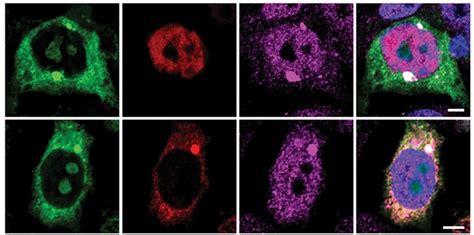 In ALS and FTD, Two Different Routes to TDP-43 Aggregation | ALZFORUM