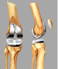 Total Knee Replacement – Orland Park Orthopedics