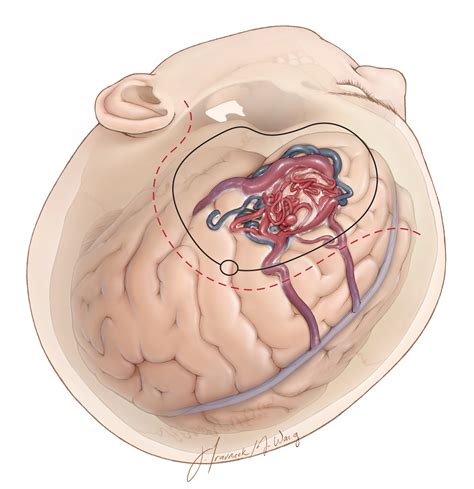 Nuances in AVM Resection | The Neurosurgical Atlas