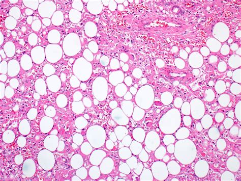 Pathology Outlines - Angiomyolipoma