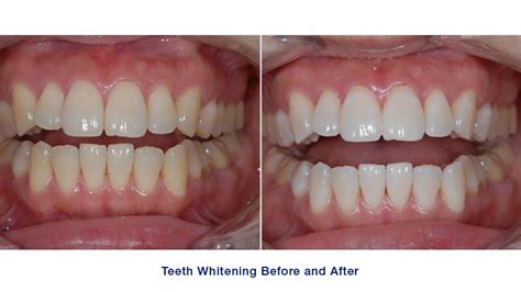 how to use home teeth whitening trays