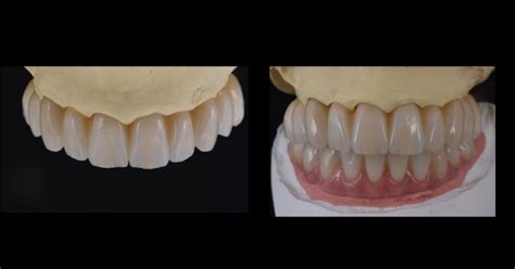 Zygomatic Implants vs. Bone Grafting for Full Arch Solutions - Spear Education