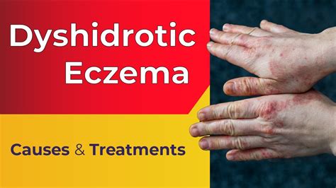 What is Dyshidrotic Eczema? - Overview, Causes, Treatments - YouTube
