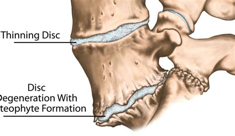 Bone Spurs of the Spine – What Causes Them and How Can They Be Treated? | Patrick Senatus, M.D.