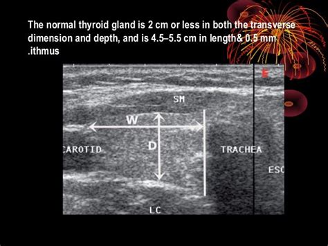 Thyroid ultrasound