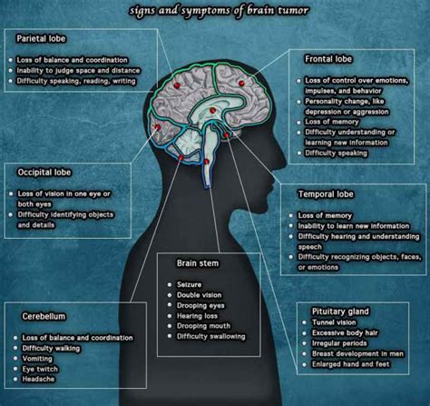 10 Warning Signs And Symptoms Of Brain Tumors You Should Know