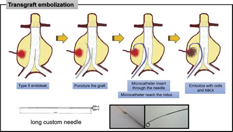 Transgraft embolization by using long needle for the treatment of type ...