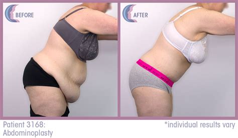 Amazing Tummy tuck before & afters | Tummy tucks, Liposuction, Tummy