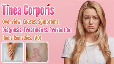 Tinea corporis overview, causes, sign and symptoms, diagnosis, treatment, home remedies and FAQs ...