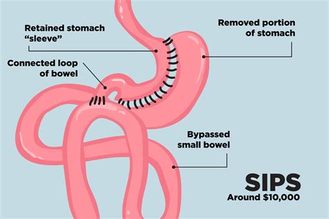 The Top Weight Loss Surgery Procedures | Reader's Digest