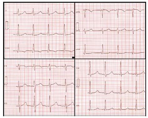 Association of Short PR Interval, Long QT Interval, and Sudden Cardiac ...