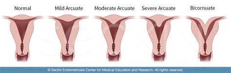 Arcuate Uterus: Causes, Symptoms, Diagnosis Treatment, 45% OFF