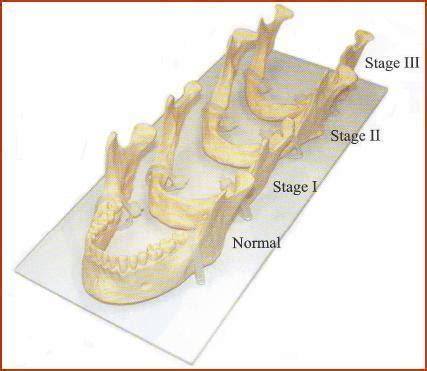 Jaw bone loss occurs without dental implants - Bauer Smiles